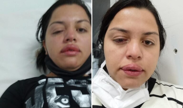 Faxineira atacada pelo ex-patrão com ácido teme perder visão de um olho: 'Não consigo enxergar' 8 Faxineira atacada pelo ex-patrão com ácido teme perder visão de um olho: 'Não consigo enxergar'