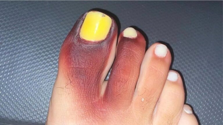 Mulher fica com dedo roxo e unha amarela ao calçar tênis com ‘piolho-de-cobra’ 15 Mulher fica com dedo roxo e unha amarela ao calçar tênis com ‘piolho-de-cobra’
